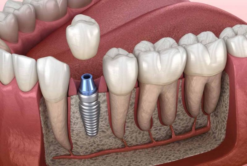 Você sabe qual a importância da Implantodontia para a saúde dos pacientes?
